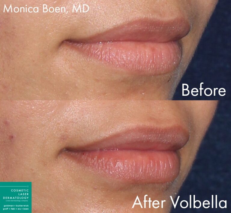 Before and after oblique image of Volbella treatment on a female's lips performed by Dr. Boen at our San Diego medical spa