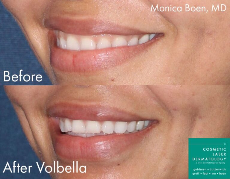 Before and after oblique image of Volbella injections to augment a female's lips performed by Dr. Boen at our San Diego medi spa