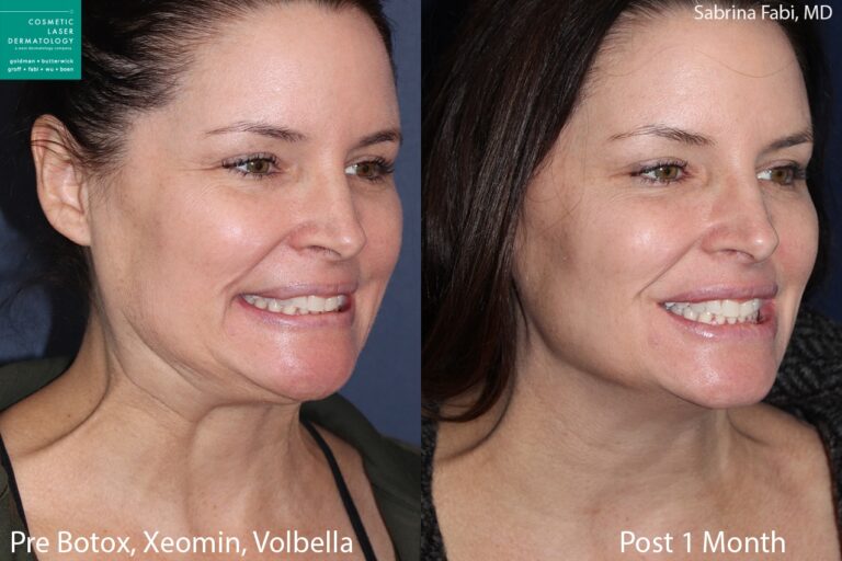 Botox and Xeomin for crow's feet, Volbella for lip augmentation by Dr. Fabi. Treatment smooths away lines around eyes and adds subtle fullness to lips.