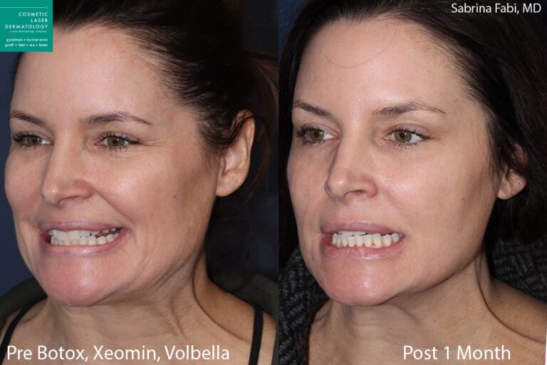 Botox and Xeomin for crow's feet and neck rejuvenation, Volbella for lip augmentation by Dr. Fabi. Treatment reduces lines around the eyes and neck, while adding subtle plumping to the lips.