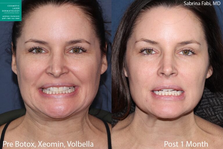Botox and Xeomin for wrinkles and neck rejuvenation, Volbella for lip enhancement by Dr. Fabi. Treatment minimizes the appearance of lines on the face and neck, while adding subtle enhancement to lips.