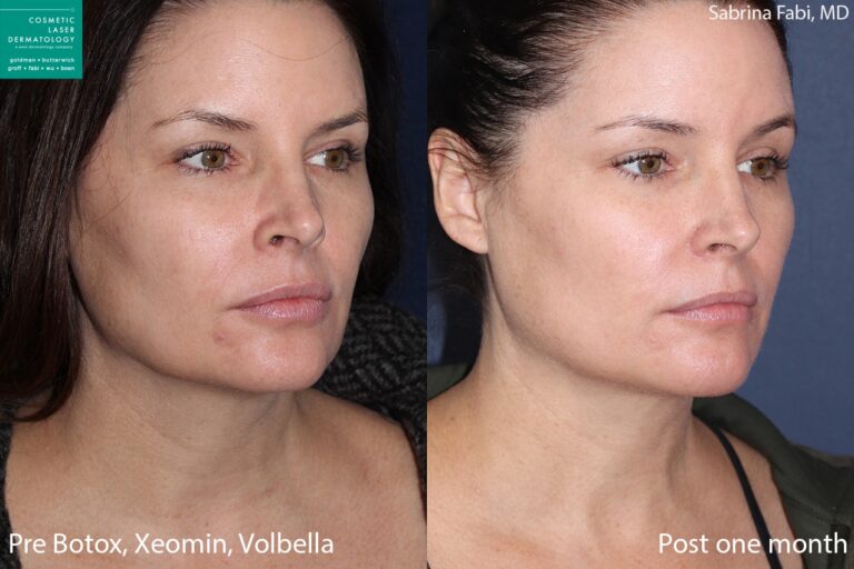 Botox, Xeomin, and Volbella to rejuvenate the face and neck by Dr. Fabi. After treatment, skin is smoother with fewer lines and wrinkles.