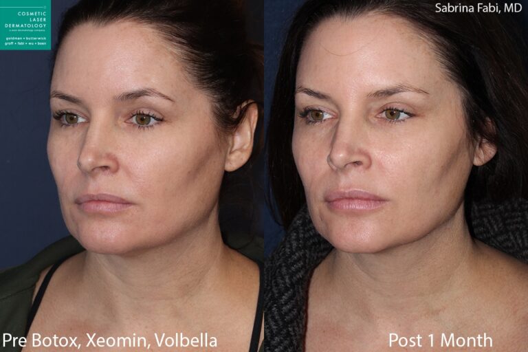 Botox, Xeomin, and Volbella to rejuvenate the face and neck by Dr. Fabi. Treatment minimizes appearance of lines and wrinkles for a refreshed appearance.
