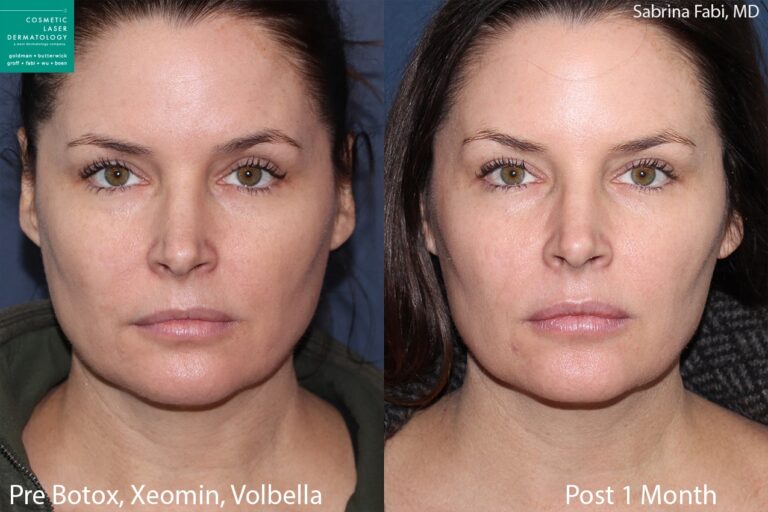 Botox, Xeomin and Volbella for rejuvenating the face and neck by Dr. Fabi. Treatment creates smoother skin with a visible reduction in lines and wrinkles.