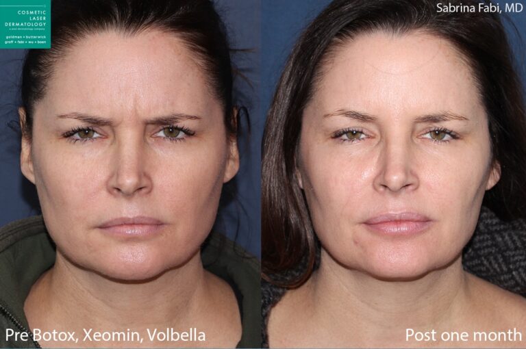 Botox and Xeomin to treat frown lines by Dr. Fabi. After treatment, vertical lines between the eyebrows are visibly reduced.