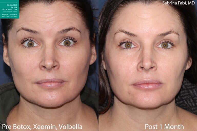 Botox and Xeomin for wrinkles and Volbella for lip augmentation by Dr. Fabi. After treatment, forehead lines are reduced and lips are fuller.