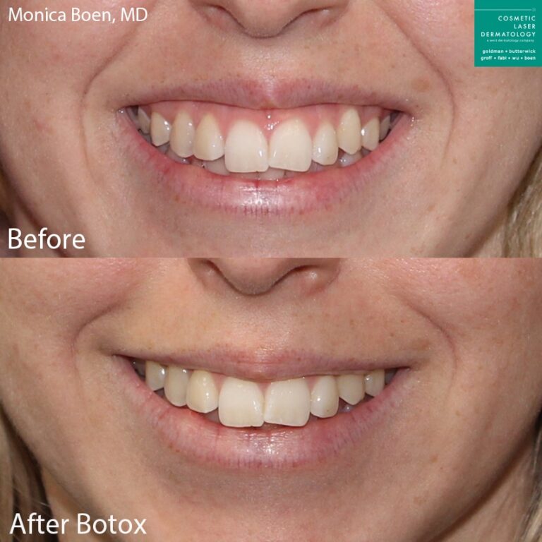 Botox for gummy smile reduction by Dr. Boen. Treatment lowers upper lip line slightly to eliminate gummy show when patient smiles.