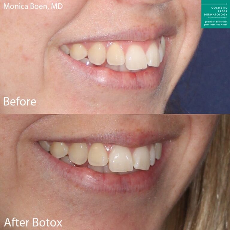 Botox to treat a gummy smile by Dr. Boen. After treatment upper lip is slightly lower to hide gum show.