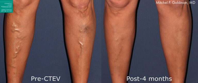 CTEV to treat varicose veins by Dr. Goldman. After treatment, bulges in front of legs caused by swollen varicose veins are gone.