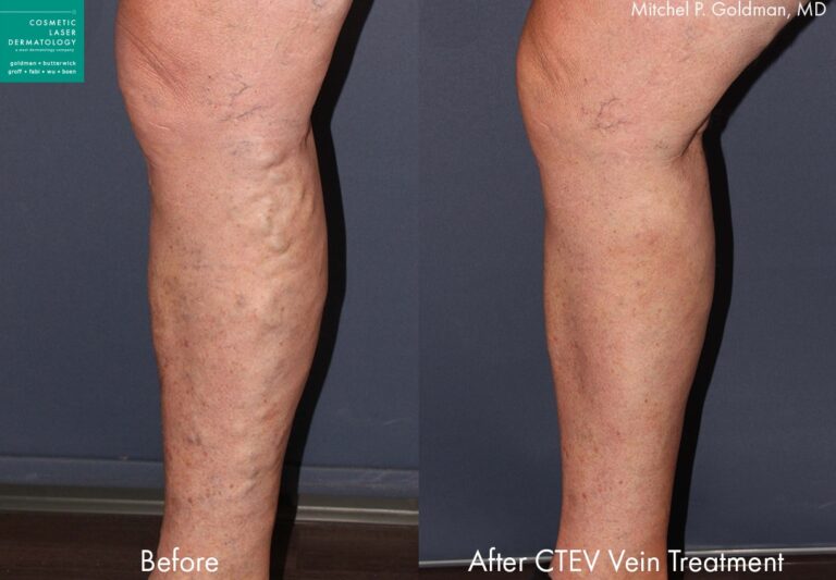 CTEV to remove varicose veins by Dr. Goldman. Treatment eliminates bulging legs on the back of the calf.