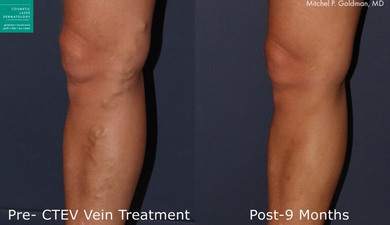 CTEV to remove varicose veins by Dr. Goldman. Treatment removes visible veins that were protruding above the skin's surface.