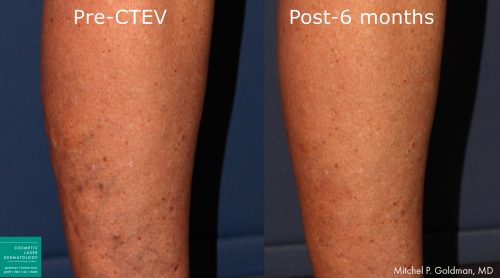 CTEV to treat varicose veins by Dr. Goldman. After treatment, bulging veins are visibly reduced.