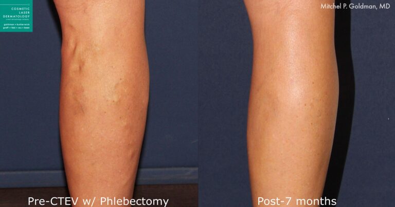 CTEV to remove varicose veins by Dr. Goldman. Treatment removes bulging vessels from lower leg.