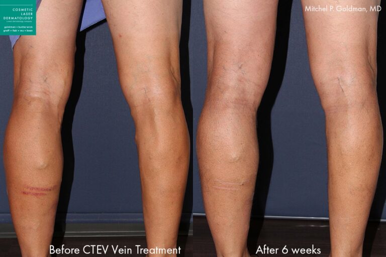 CTEV to treat leg veins by Dr. Goldman. Laser removes bulging veins from lower leg.