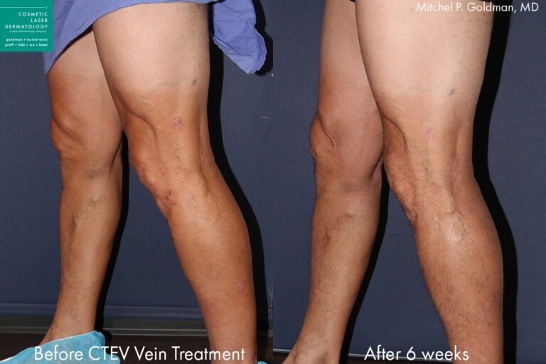CTEV to treat leg veins by Dr. Goldman. After treatment, visible veins are gone and legs are smoother.