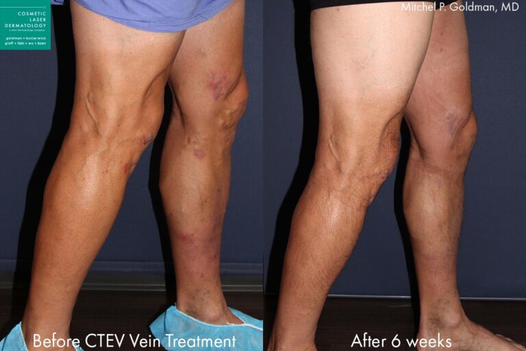 CTEV to treat varicose veins by Dr. Goldman. Treatment removes bulging vessels from leg behind knee.