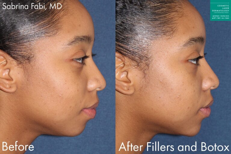 Filler and Botox for facial contouring by Dr. Fabi. Treatment slims jawline and augments midface and chin for a more attractive facial profile.