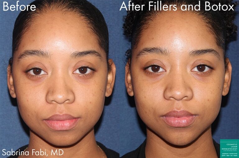 Fillers and Botox for facial contouring by Dr. Fabi. Botox narrows the jawline while fillers augment the chin and midface.