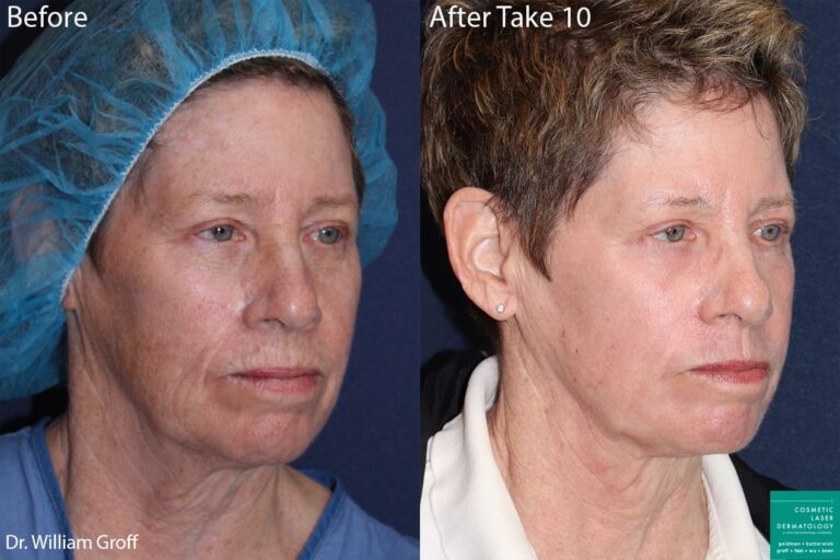 Take 10 treatment with laser resurfacing using Vbeam, Alexandrite, and Fraxel lasers to rejuvenate the skin by Dr. Groff. Treatment smooths and rejuvenates skin, increasing firmness and reducing lines and wrinkles.