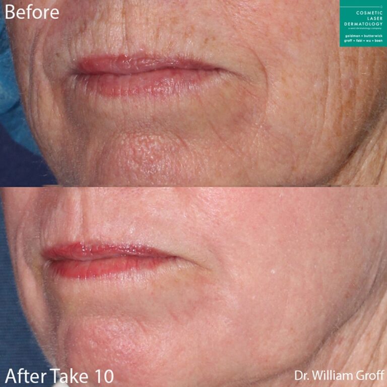 Take 10 treatment with laser resurfacing using Vbeam, Alexandrite, and Fraxel lasers to rejuvenate the skin by Dr. Groff. Treatment reduces perioral lines and other wrinkles around the mouth and chin.