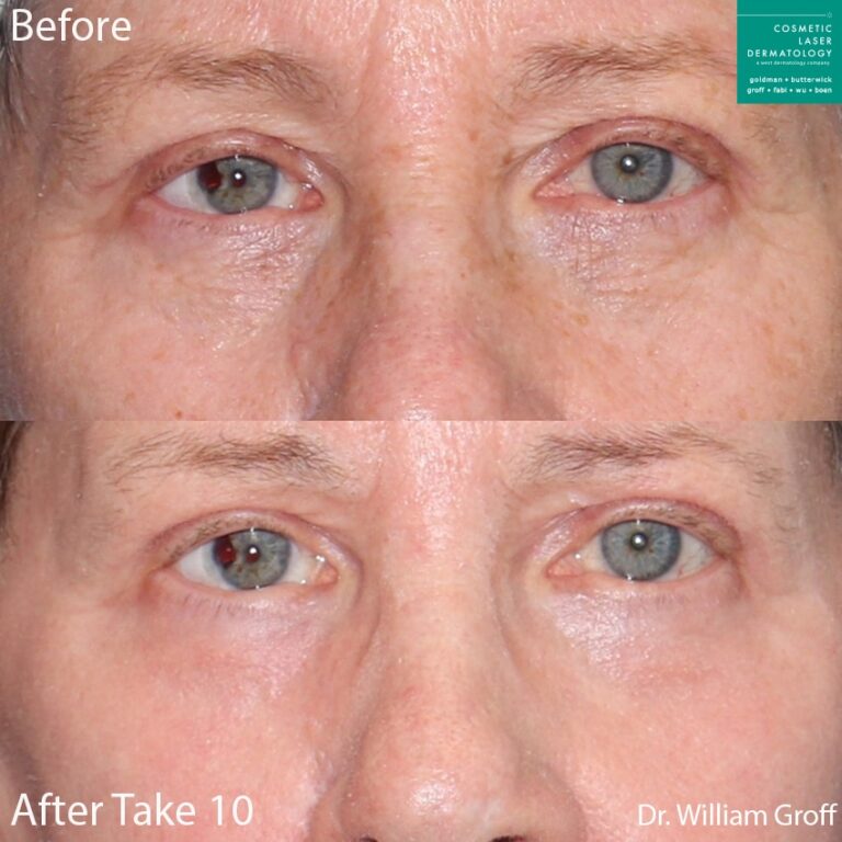 Take 10 treatment with laser resurfacing using Vbeam, Alexandrite, and Fraxel lasers to rejuvenate the skin by Dr. Groff. Procedure creates a refreshed appearance with smoother skin and fewer lines and wrinkles.