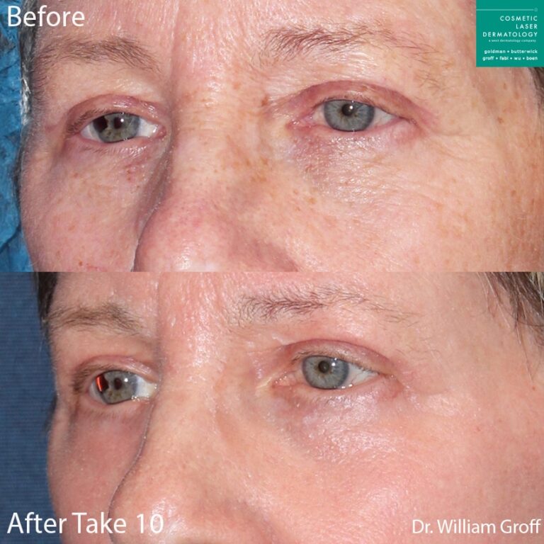 Take 10 treatment with laser resurfacing using Vbeam, Alexandrite, and Fraxel lasers to rejuvenate the skin by Dr. Groff. Treatment refreshes eye area