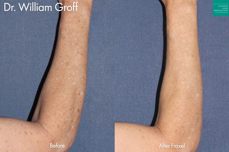 Before and after Fraxel Dual to treat sun damage on the arm by Dr. Groff. After treatment, brown spots and discoloration are visibly reduced.
