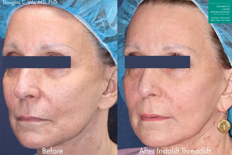 InstaLift threadlift for rejuvenation by Dr. Wu. After treatment, patient's face is visibly lifted and smoother.