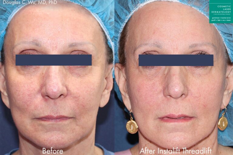 Silhouette InstaLift threadlift to reverse aging symptoms and rejuvenate the appearance by Dr. Wu. After treatment, patient's face is visibly lifted and smoother, with fewer lines and creases.