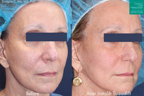 Silhouette InstaLift threadlift for skin sagging and aging symptoms by Dr. Wu. After treatment, skin is visibly lifted and firmer with fewer lines and wrinkles.