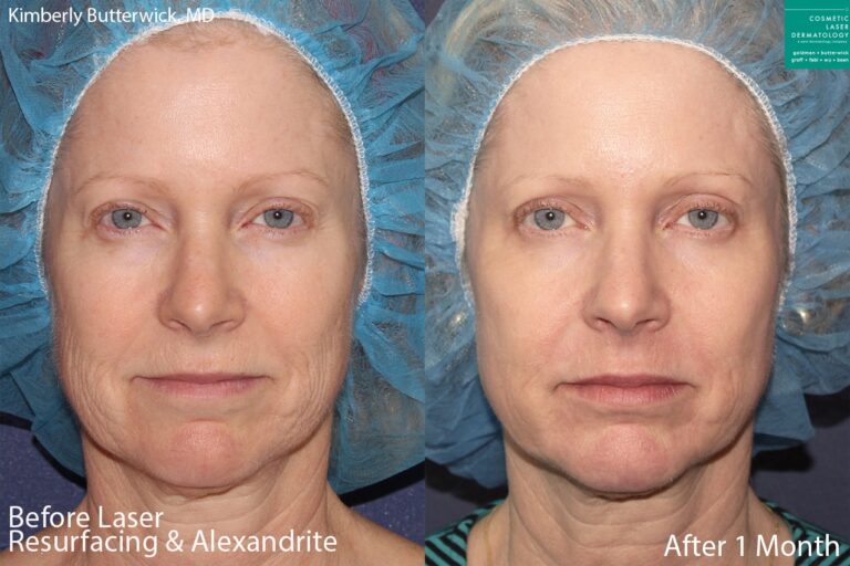 Laser resurfacing and Alexandrite laser to rejuvenate the skin by Dr. Butterwick. Treatment leaves skin smoother and firmer, with fewer fine lines.