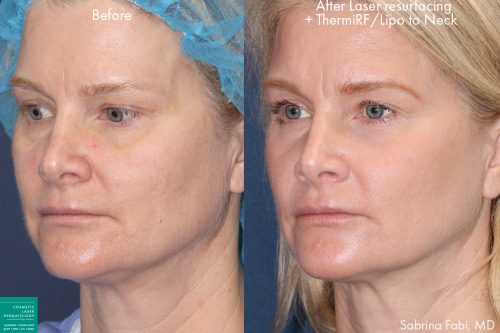 Laser resurfacing, ThermiRF, neck lipo for skin rejuvenation and contouring by Dr. Fabi. After treatment, skin is firmer with fewer lines and jawline is more defined.