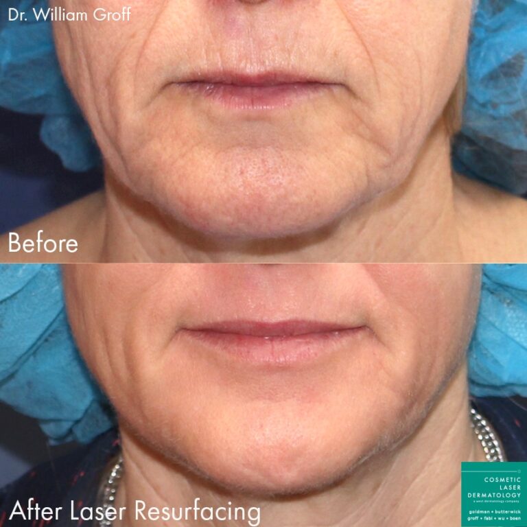 Laser resurfacing to rejuvenate skin around the mouth by Dr. Groff. Treatment eliminates deep lines and creases while creating smoother skin.