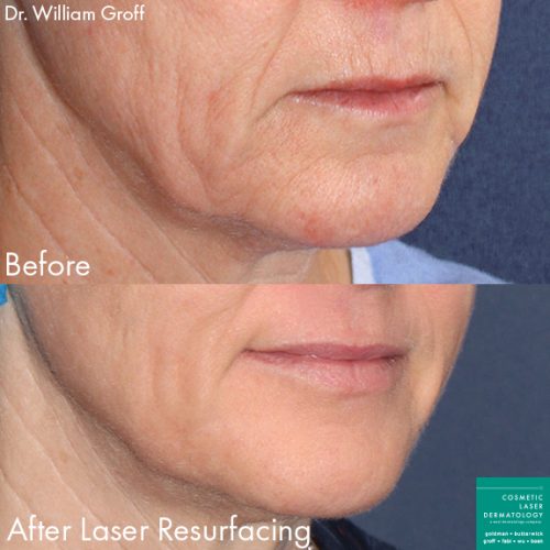 Laser resurfacing to rejuvenate the skin around the mouth by Dr. Groff. Treatment produces smoother skin with fewer lines around the mouth and jawline.