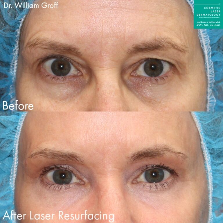 Laser resurfacing for skin rejuvenation around the eyes by Dr. Groff. After treatment, dark circles are minimized and skin is smoother and brighter.