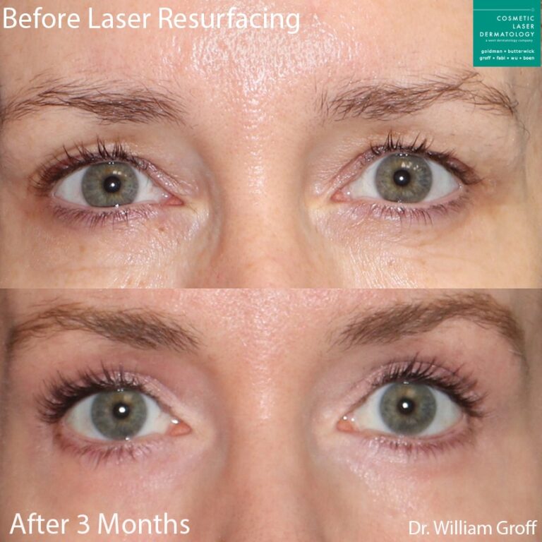 Laser resurfacing to rejuvenate the skin around the eyes by Dr. Groff. After treatment, skin is smoother with fewer fine lines and eyes look more awake.