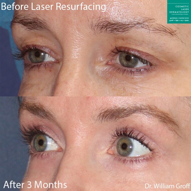 Laser resurfacing to rejuvenate the skin around the eyes by Dr. Groff. After treatment, skin is smoother and eyes are more open.
