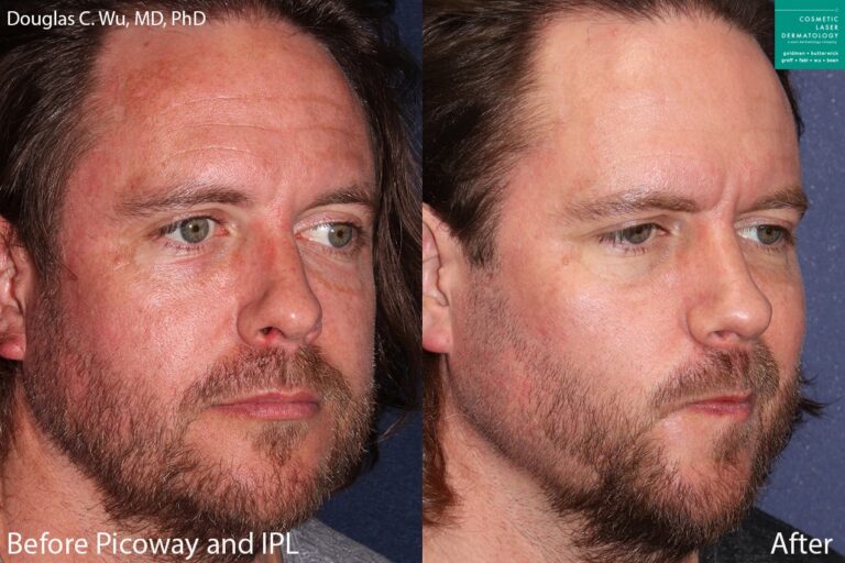 PicoSure laser and IPL to treat sun damage and rejuvenate the skin by Dr. Wu. After treatment, brown spots and hyperpigmentation are gone.