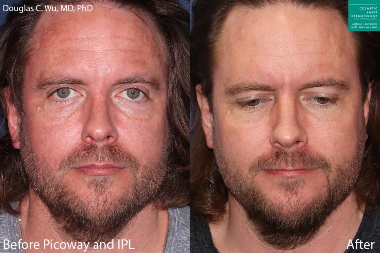 PicoSure laser and IPL to treat sun damage and rejuvenate the skin by Dr. Wu. Treatment addresses hyperpigmention and brown spots to produce clearer skin.