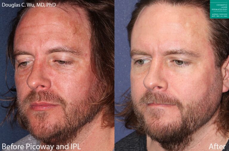 PicoSure and IPL to treat sun damage and rejuvenate the skin by Dr. Wu. Treatment removes hyperpigmentation to produce clearer, fresher skin.