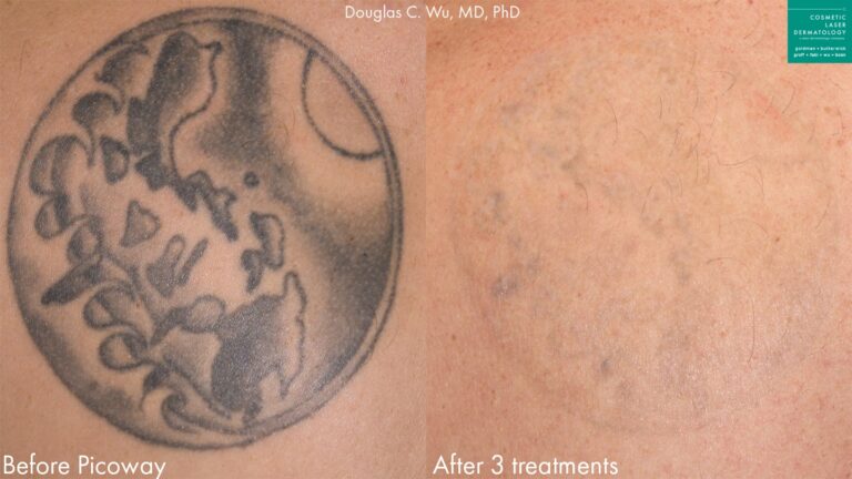 PicoWay laser to remove tattoo by Dr. Wu. Treatments make body ink nearly undetectable.