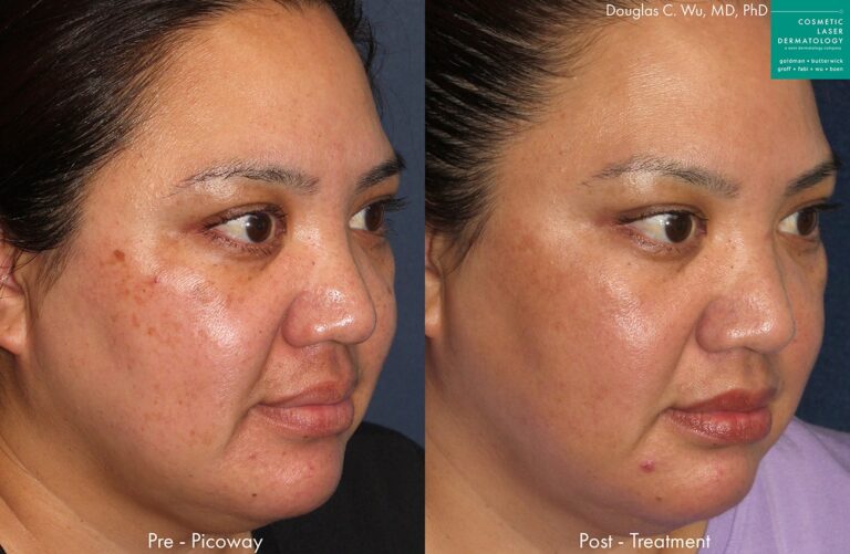 PicoWay to remove brown spots and hyperpigmentation by Dr. Wu. Treatment eliminates pigmentation to create a clearer complexion.
