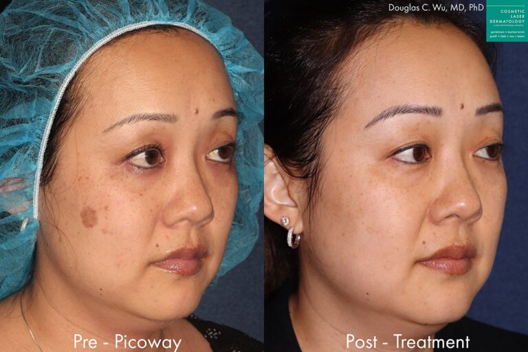PicoWay laser to remove brown spots and treat sun damage by Dr. Wu. Treatment eliminates hyperpigmentation to create clearer, fresher skin.