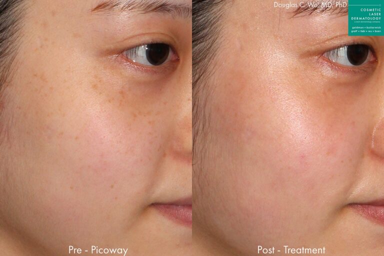 PicoWay laser to remove brown spots and treat sun damage by Dr. Wu. Treatment eliminates hyperpigmentation to create clearer, fresher skin.