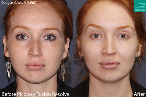 PicoWay laser to remove brown spots and treat sun damage by Dr. Wu. Treatment eliminates hyperpigmentation to create clearer, fresher skin.