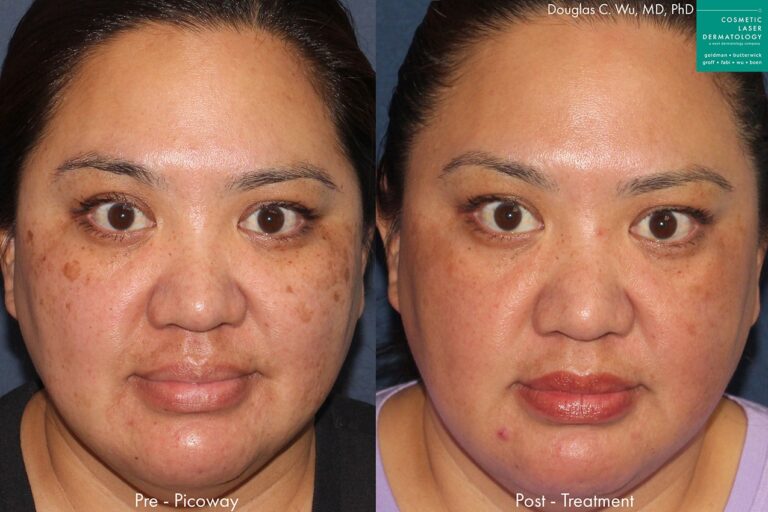 PicoWay laser to remove brown spots and treat sun damage by Dr. Wu. Treatment eliminates hyperpigmentation to create clearer, fresher skin.
