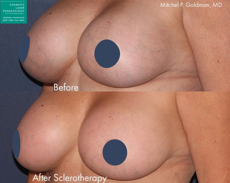 Sclerotherapy to treat spider veins by Dr. Goldman. After treatment veins are gone and breast skin is clearer.