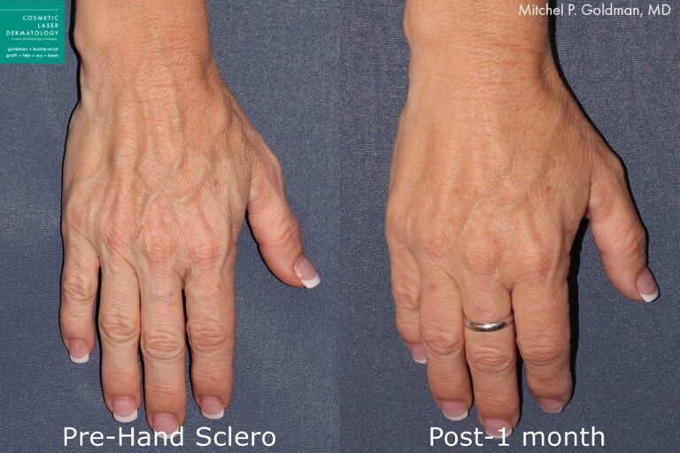 Sclerotherapy to treat prominent hand veins. After treatment, veins are visible reduced and hands look smoother and more youthful.