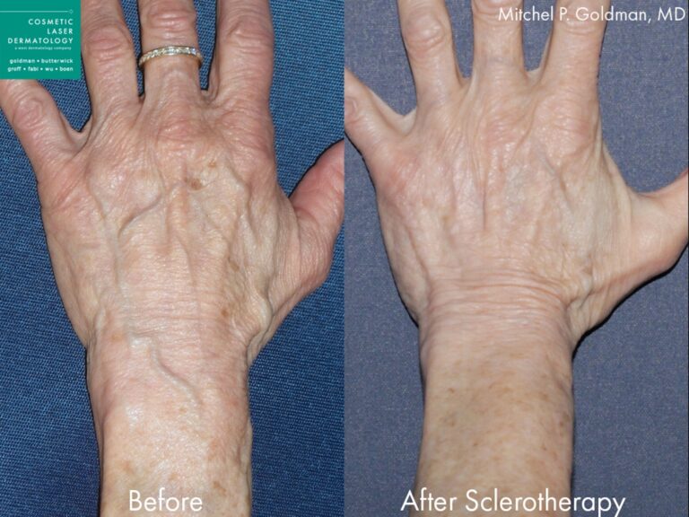 Sclerotherapy to treat hand veins by Dr. Goldman. Treatment makes veins look less prominent so hands look younger.