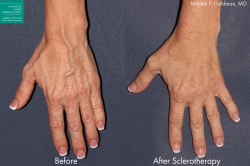 Sclerotherapy to treat hand veins by Dr. Goldman. After treatment, veins on the backs of the hands are less prominent.